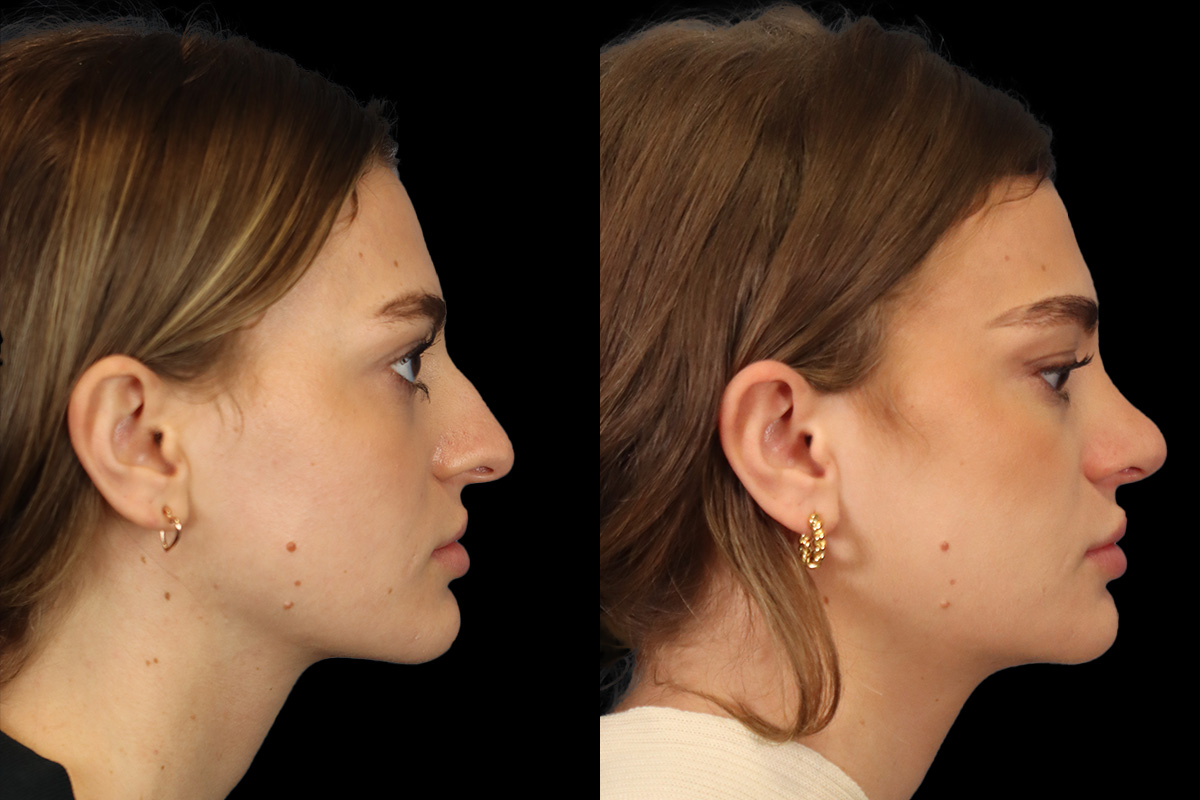 Nose Before & After Gallery - Patient 499680 - Image 4