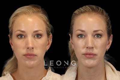 Nose Before & After Gallery - Patient 326461 - Image 1