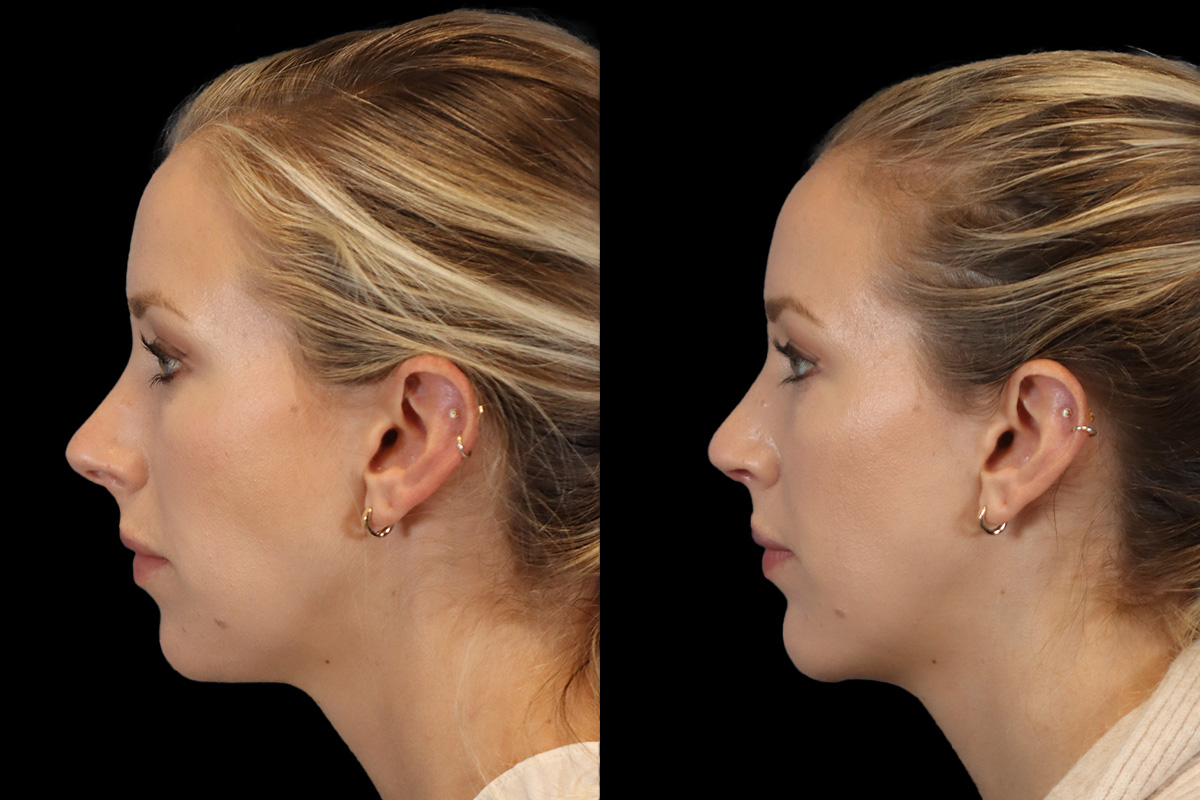 Rhinoplasty Before & After Gallery - Patient 732408 - Image 7