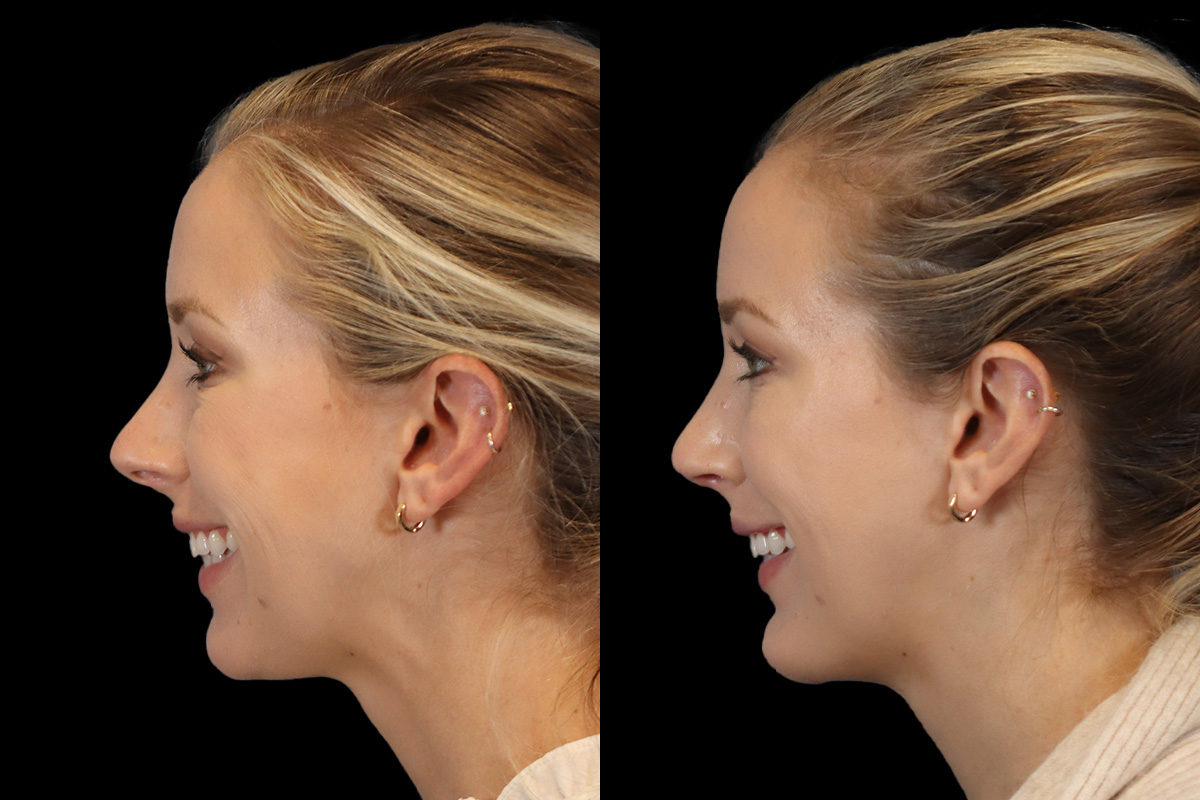 Rhinoplasty Before & After Gallery - Patient 732408 - Image 8