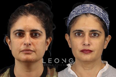 Nose Before & After Gallery - Patient 407927 - Image 1