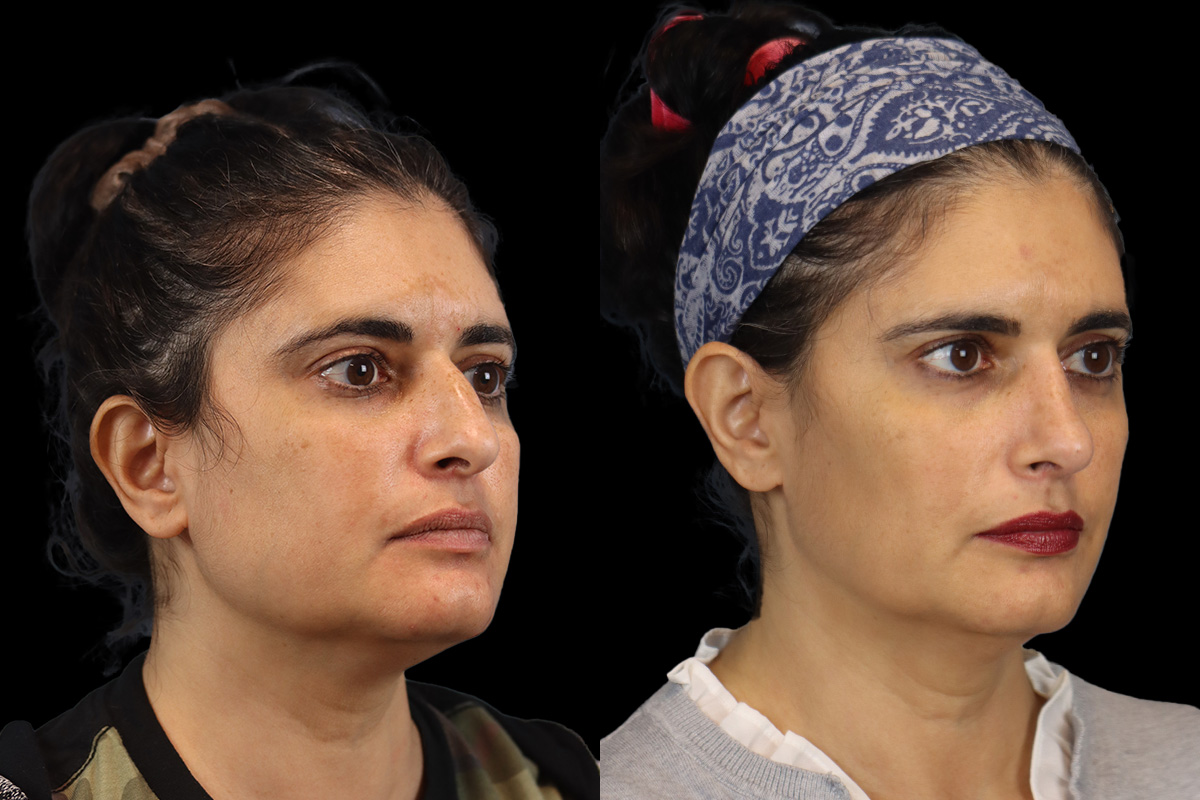 Rhinoplasty Before & After Gallery - Patient 408644 - Image 2