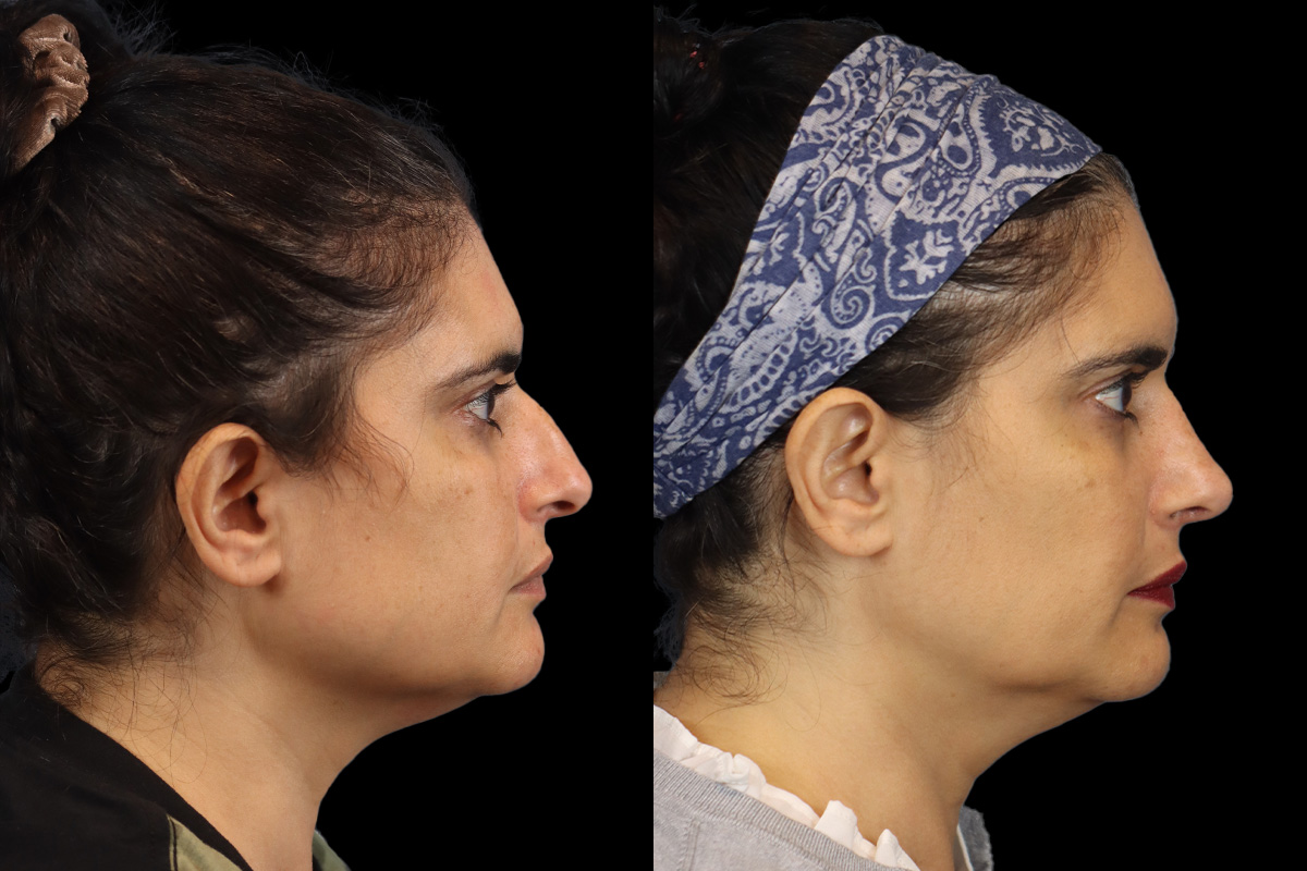 Rhinoplasty Before & After Gallery - Patient 408644 - Image 3