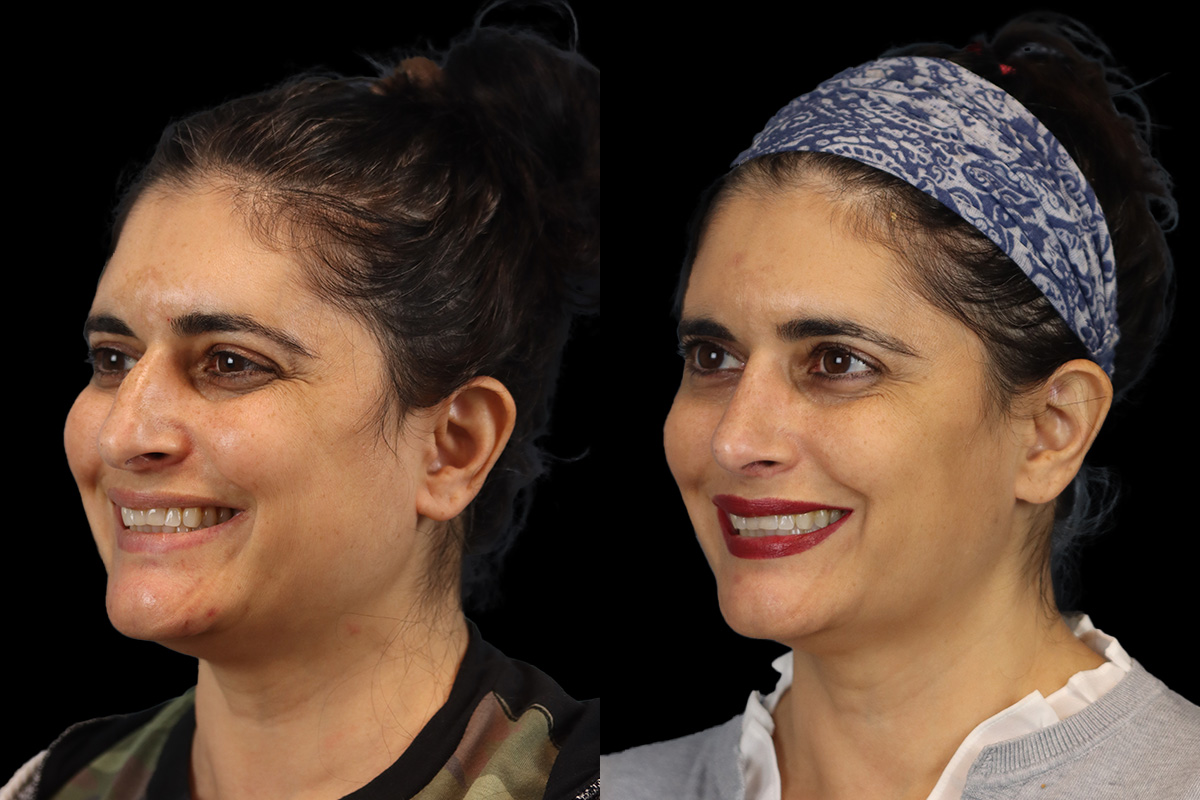 Rhinoplasty Before & After Gallery - Patient 408644 - Image 5