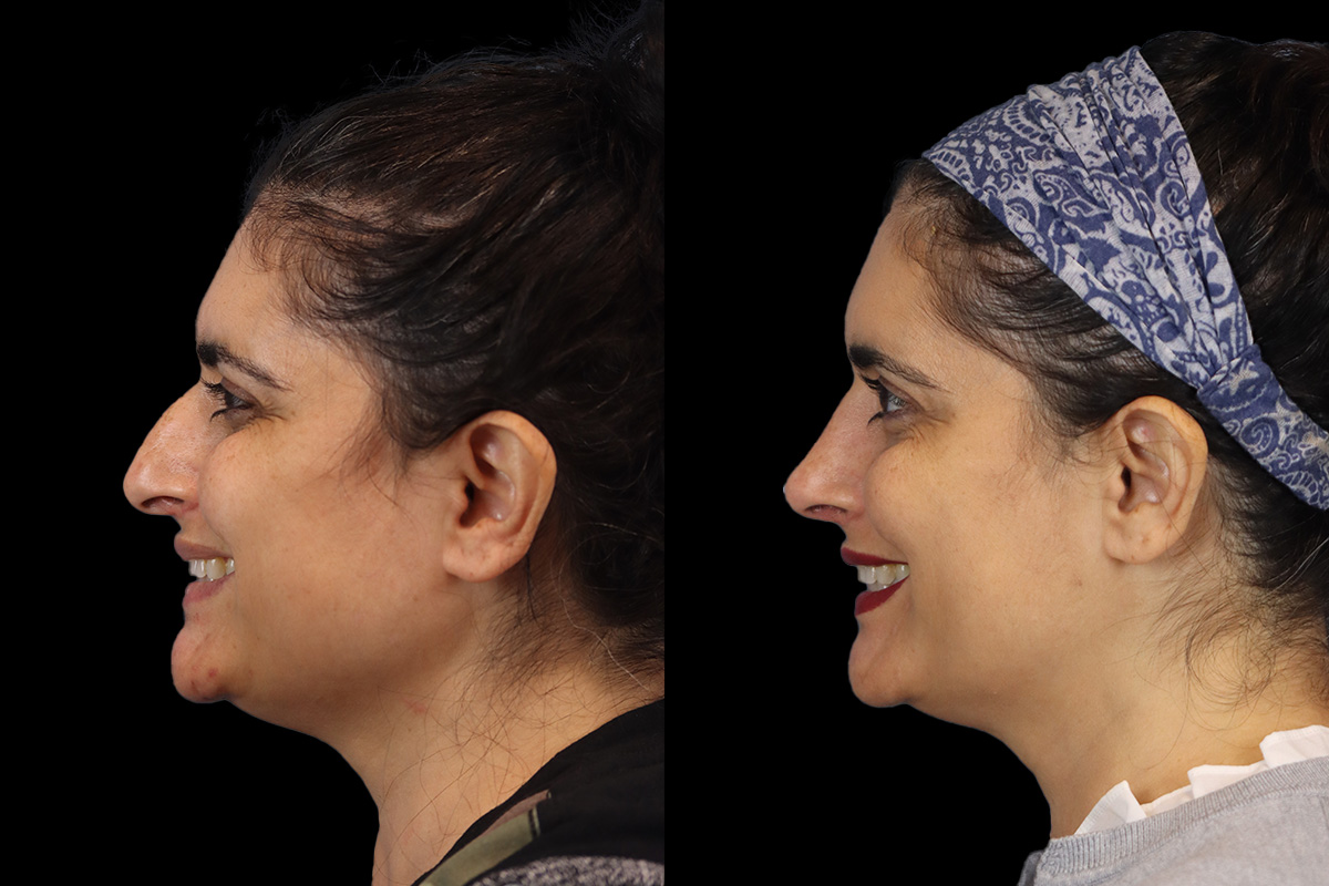 Rhinoplasty Before & After Gallery - Patient 408644 - Image 7