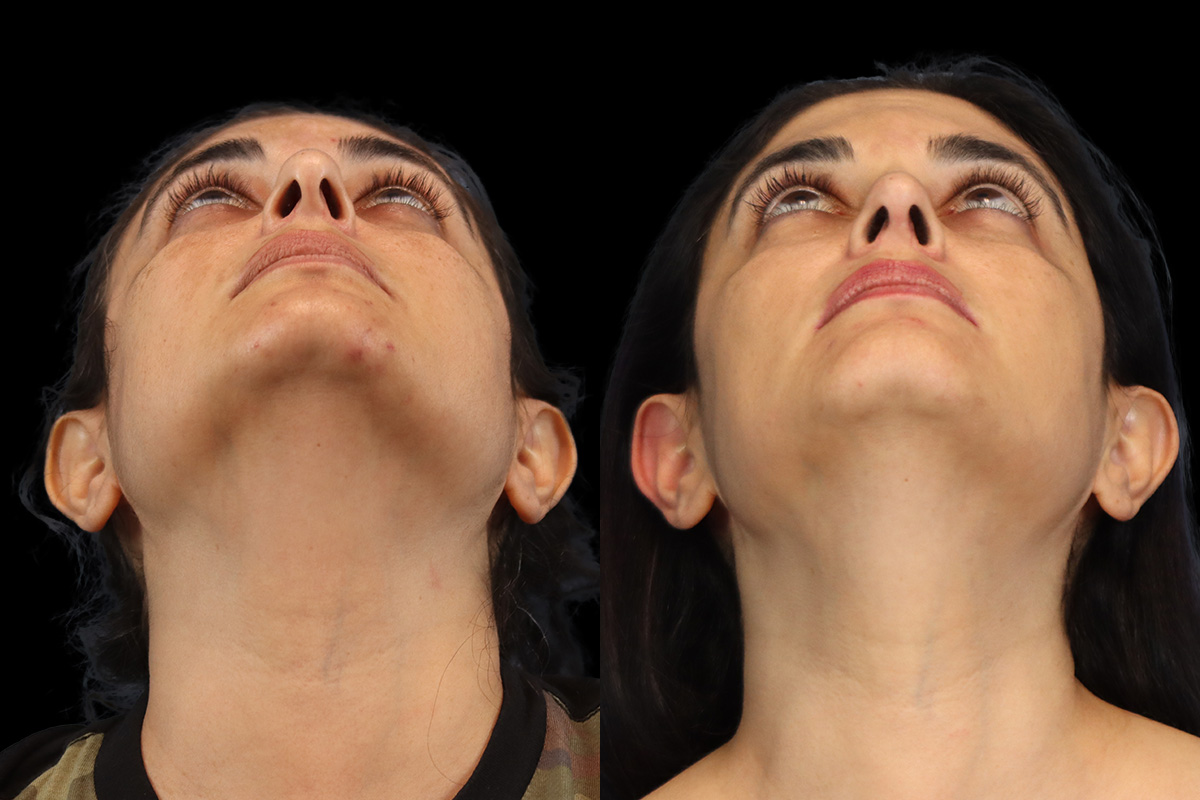 Rhinoplasty Before & After Gallery - Patient 408644 - Image 8