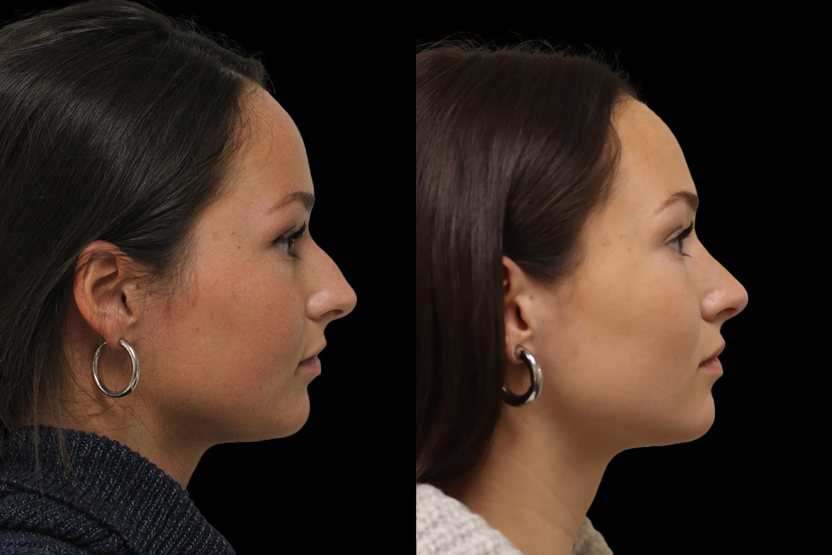 Rhinoplasty Before & After Gallery - Patient 972219 - Image 4
