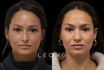 Nose Before & After Gallery - Patient 245029 - Image 1