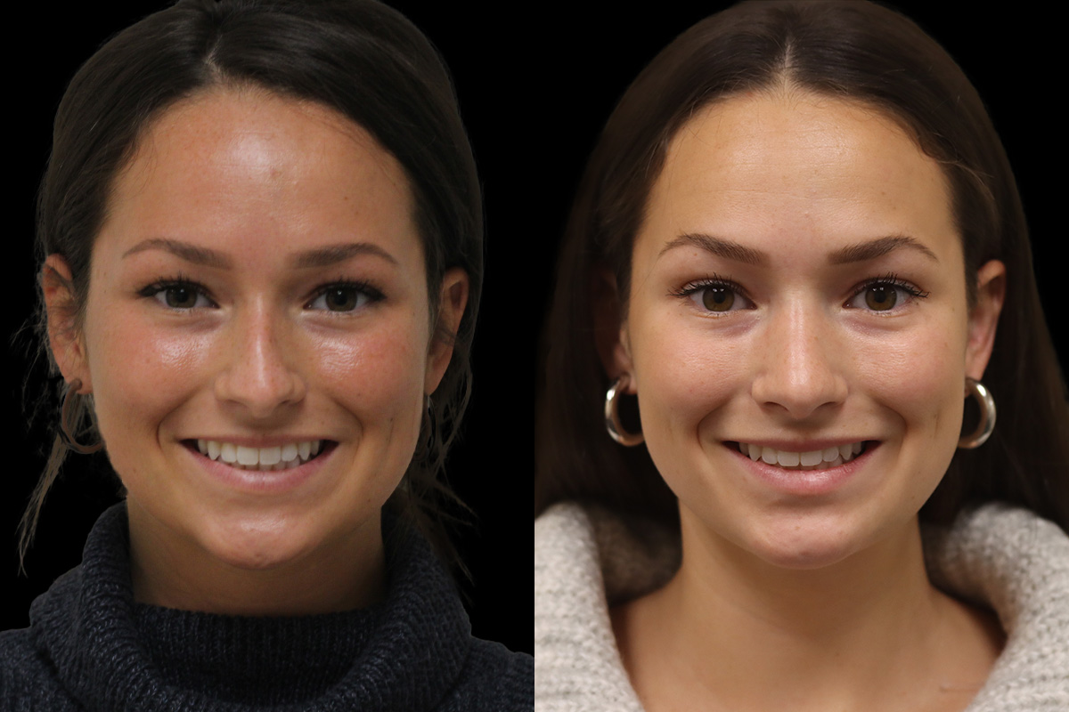 Rhinoplasty Before & After Gallery - Patient 972219 - Image 2
