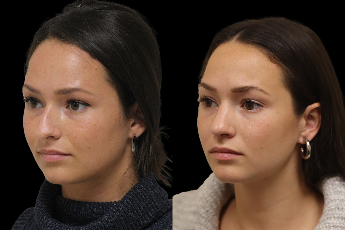 Rhinoplasty Before & After Gallery - Patient 972219 - Image 6