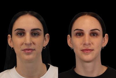 Nose Before & After Gallery - Patient 715098 - Image 1