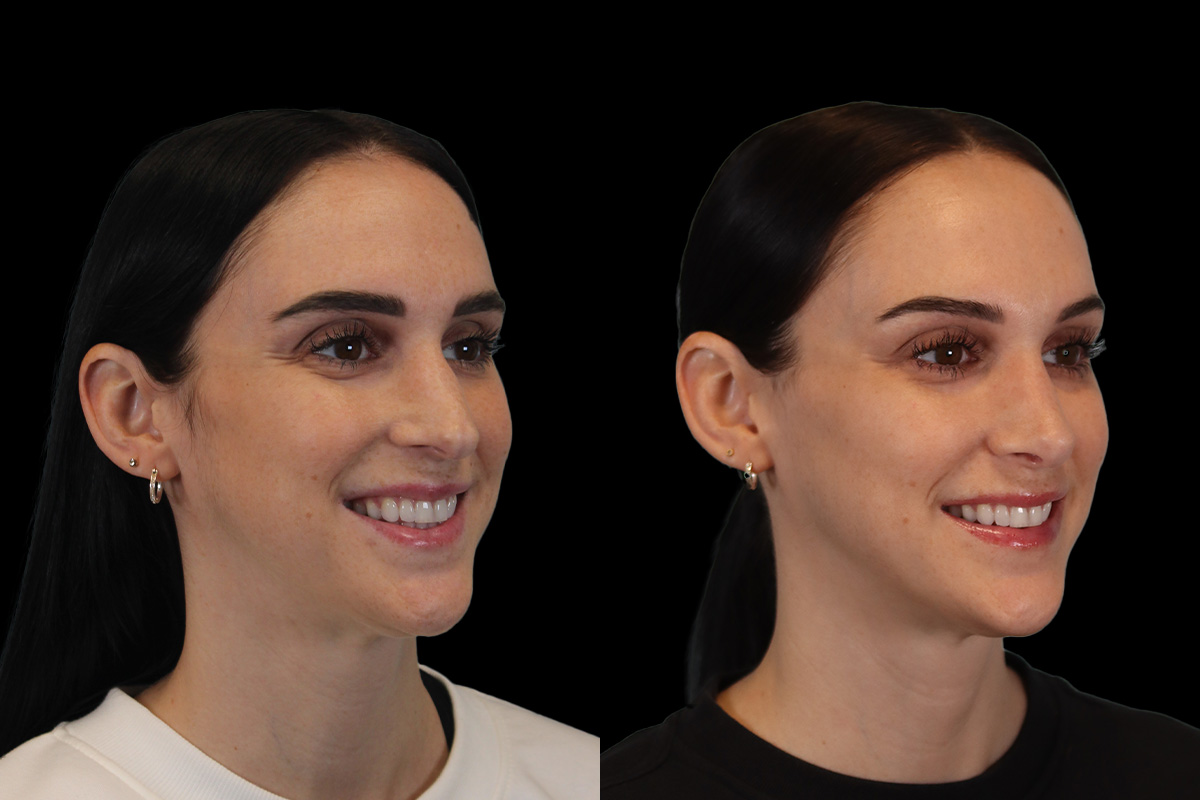 Nose Before & After Gallery - Patient 715098 - Image 4