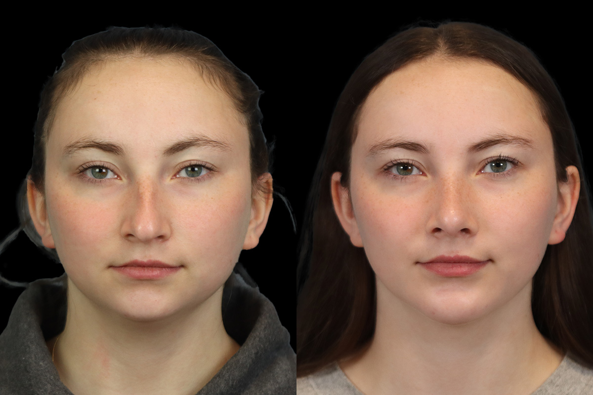 Nose Before & After Gallery - Patient 964606 - Image 1
