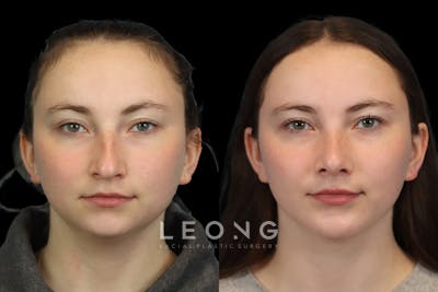 Nose Before & After Gallery - Patient 964606 - Image 1