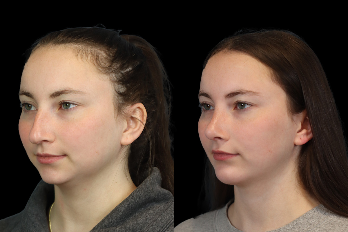 Nose Before & After Gallery - Patient 964606 - Image 6