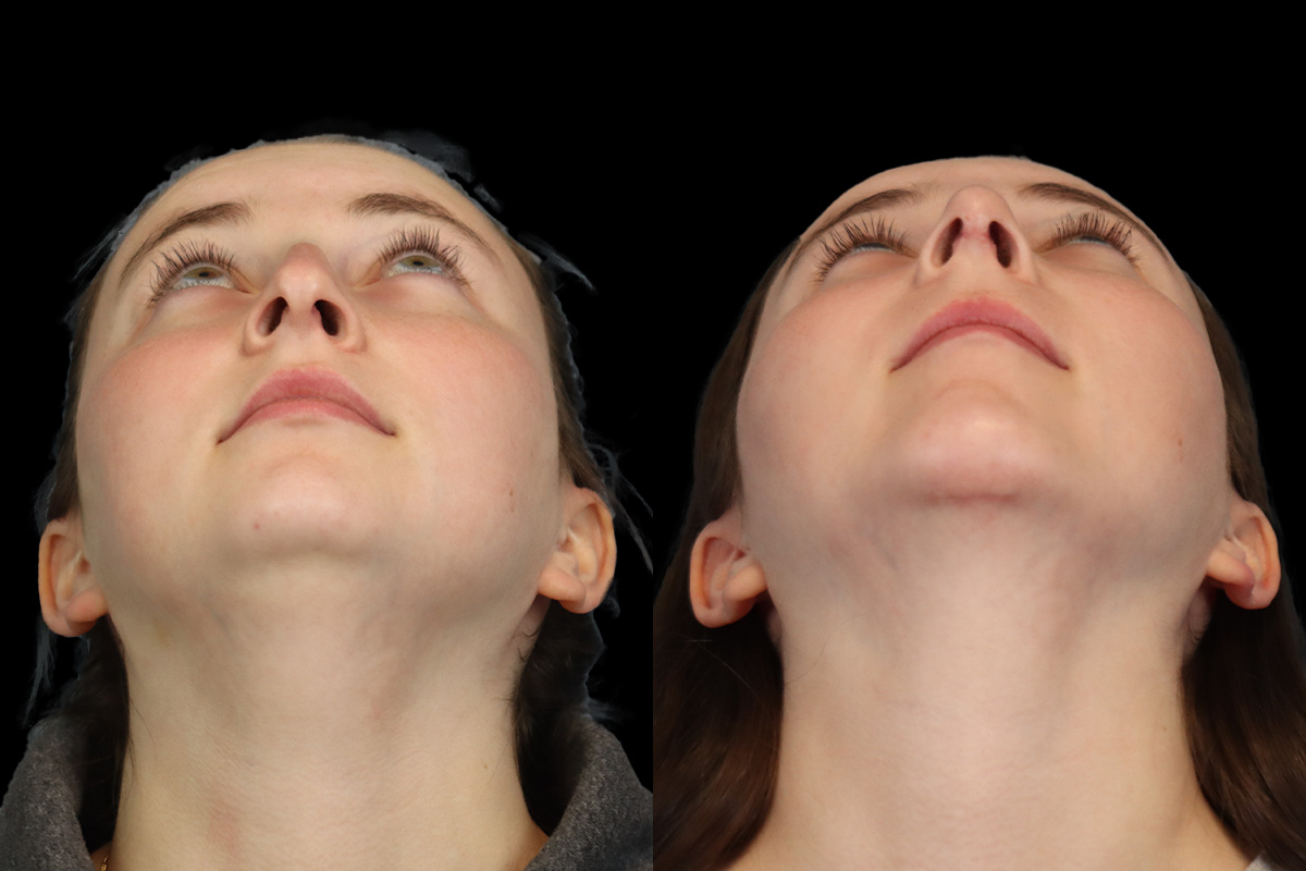 Nose Before & After Gallery - Patient 964606 - Image 9