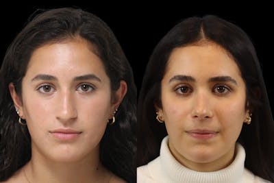 Nose Before & After Gallery - Patient 382624 - Image 1