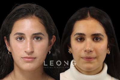 Nose Before & After Gallery - Patient 382624 - Image 1