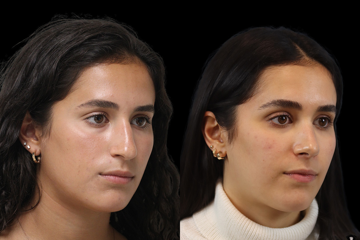 Rhinoplasty Before & After Gallery - Patient 121887 - Image 3