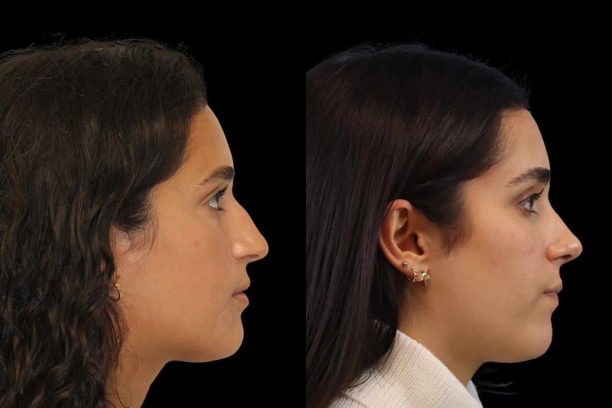 Rhinoplasty Before & After Gallery - Patient 121887 - Image 4
