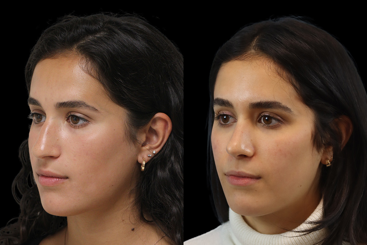Rhinoplasty Before & After Gallery - Patient 121887 - Image 6