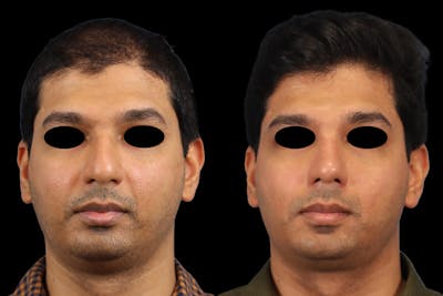 Nose Before & After Gallery - Patient 146863 - Image 1