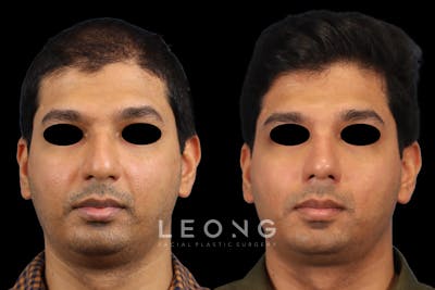 Nose Before & After Gallery - Patient 146863 - Image 1