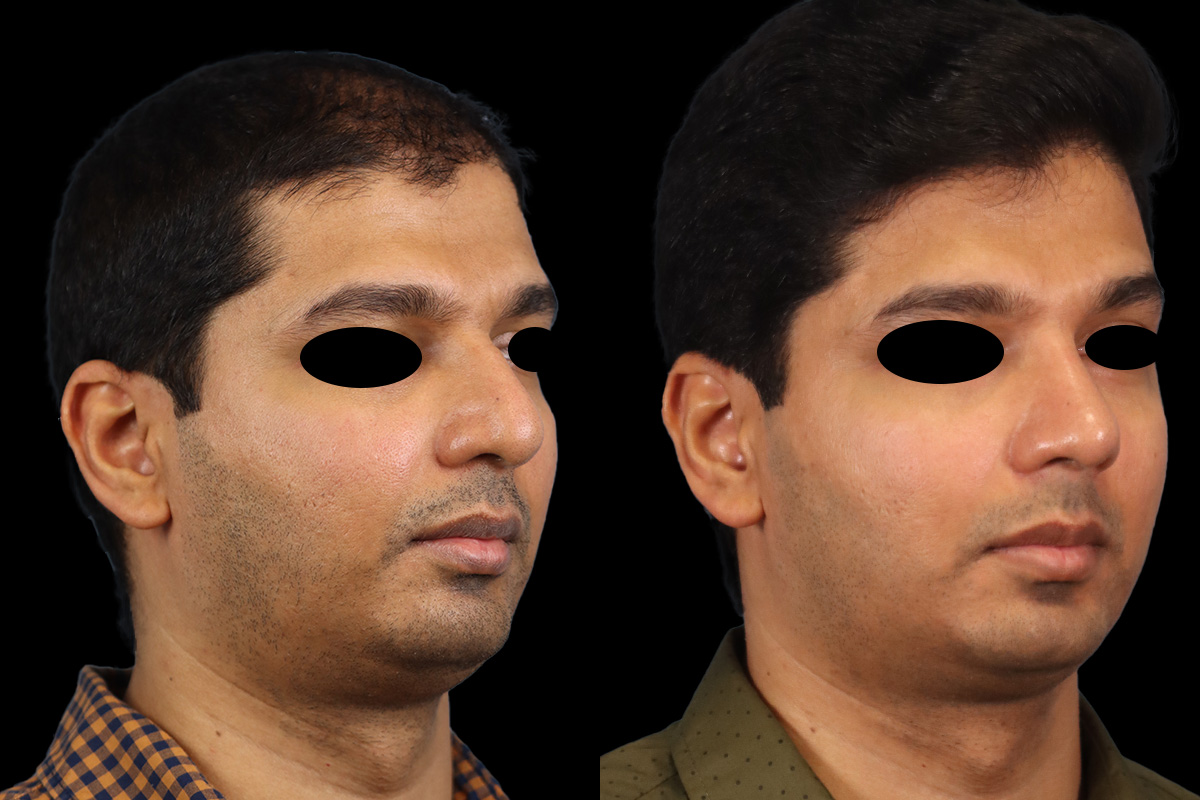 Rhinoplasty Before & After Gallery - Patient 415712 - Image 2