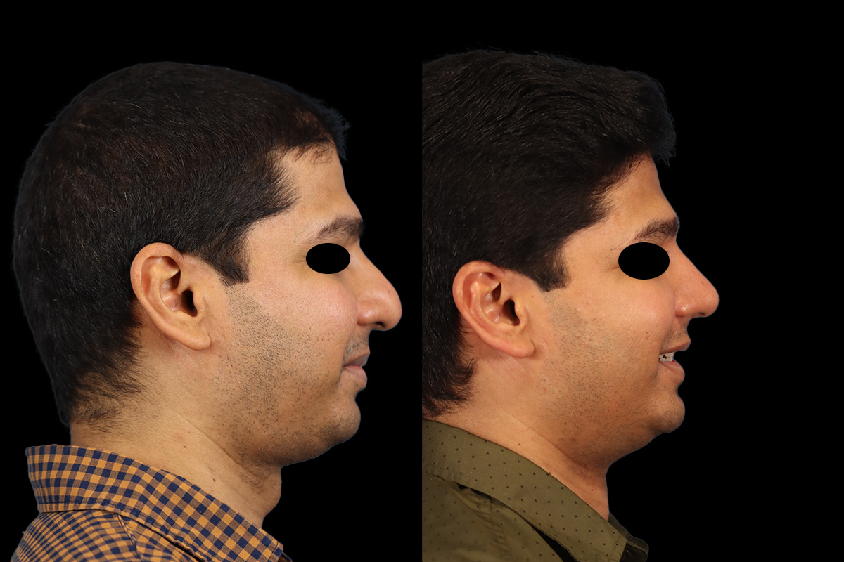 Rhinoplasty Before & After Gallery - Patient 415712 - Image 4