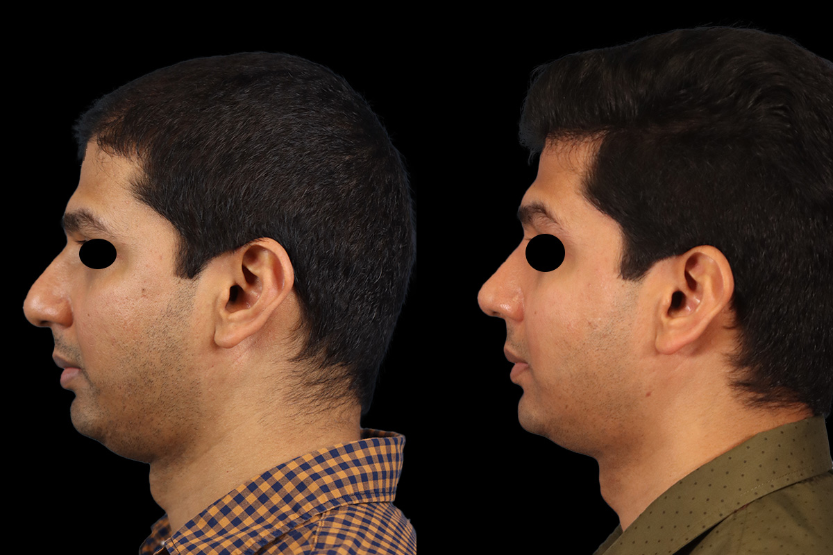 Rhinoplasty Before & After Gallery - Patient 415712 - Image 6