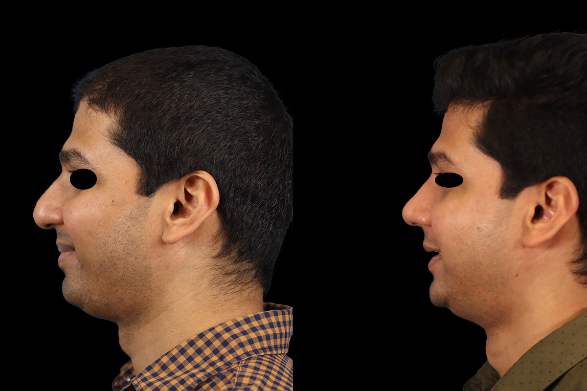 Rhinoplasty Before & After Gallery - Patient 415712 - Image 7