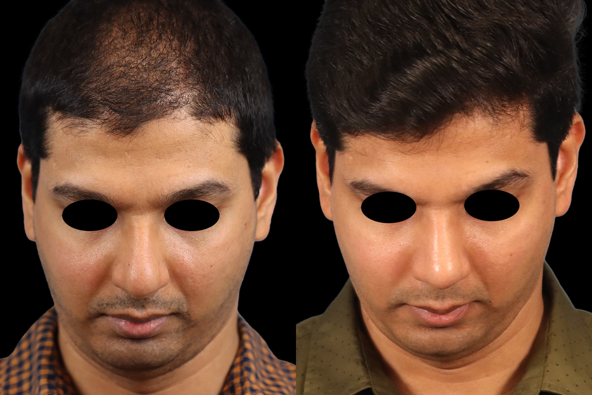 Rhinoplasty Before & After Gallery - Patient 415712 - Image 8