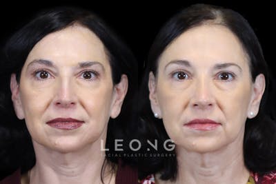 Nose Before & After Gallery - Patient 197922 - Image 1