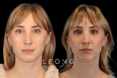 Nose Before & After Gallery - Patient 104919 - Image 1