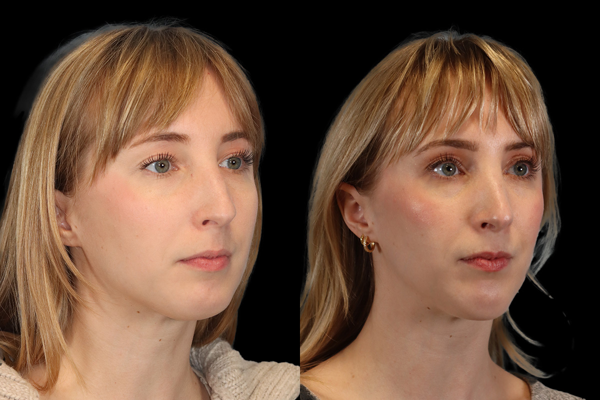 Rhinoplasty Before & After Gallery - Patient 602421 - Image 3