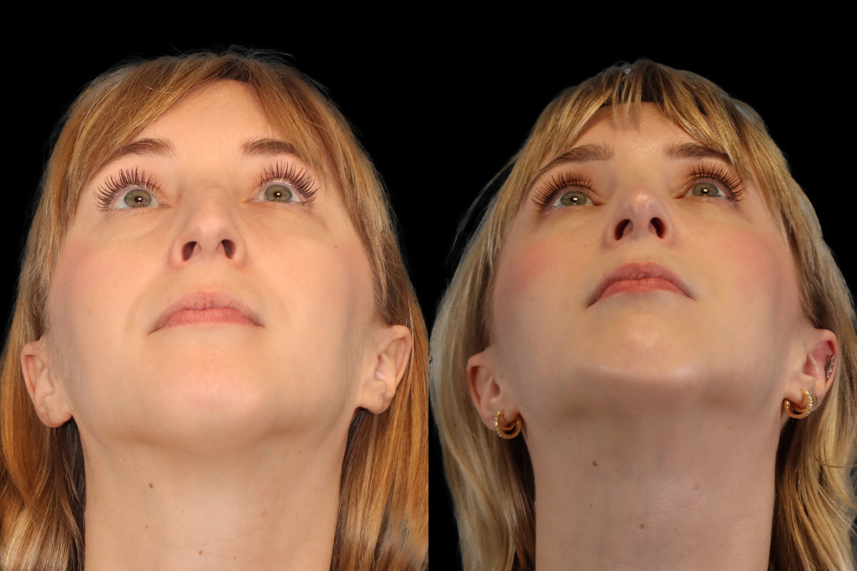 Rhinoplasty Before & After Gallery - Patient 602421 - Image 9