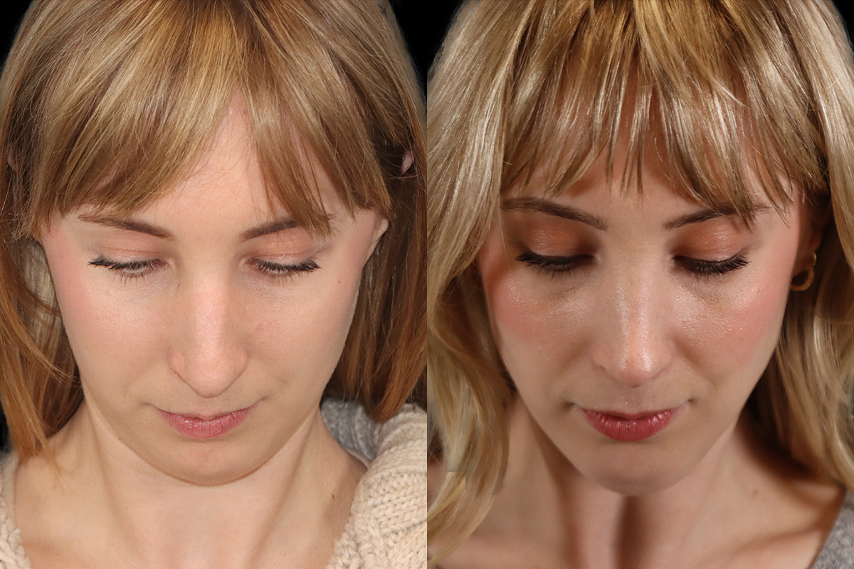 Rhinoplasty Before & After Gallery - Patient 602421 - Image 10