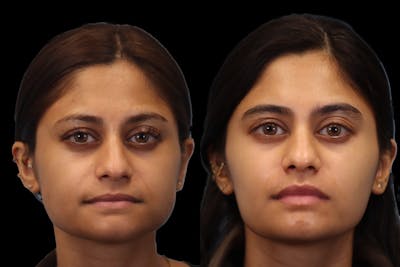 Botox® Cosmetic/ Dysport Before & After Gallery - Patient 407707 - Image 1
