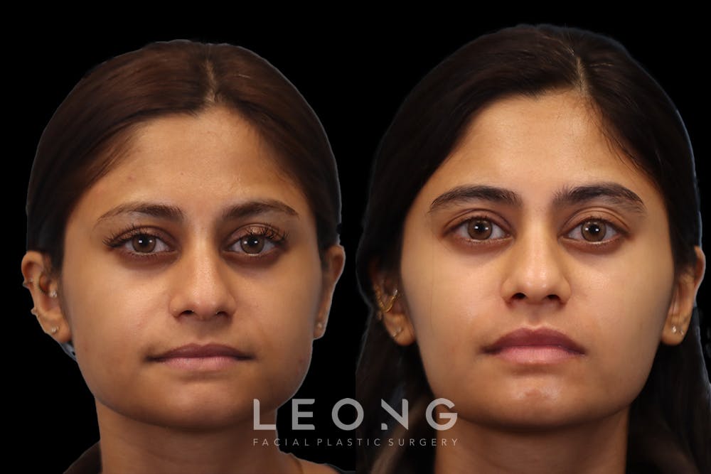 Masseter Before & After Gallery - Patient 479178 - Image 1