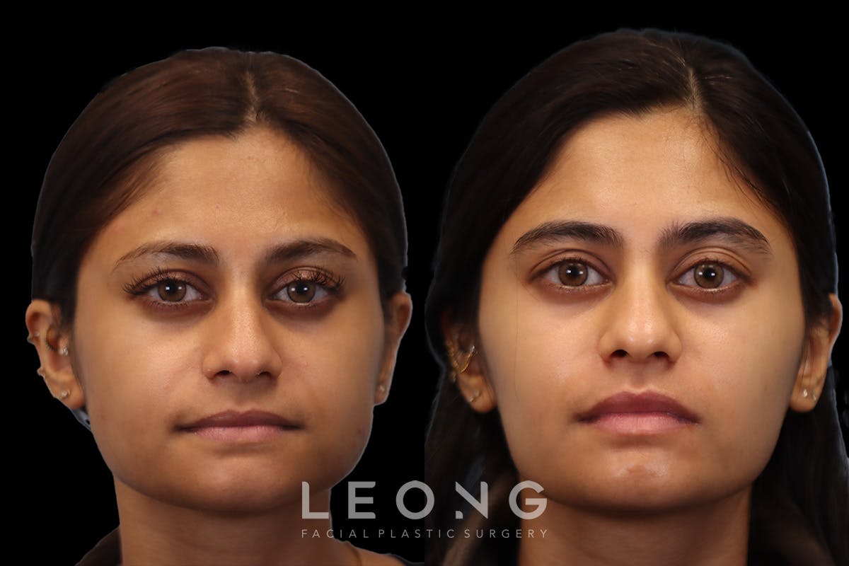 Masseter Before & After Gallery - Patient 479178 - Image 1