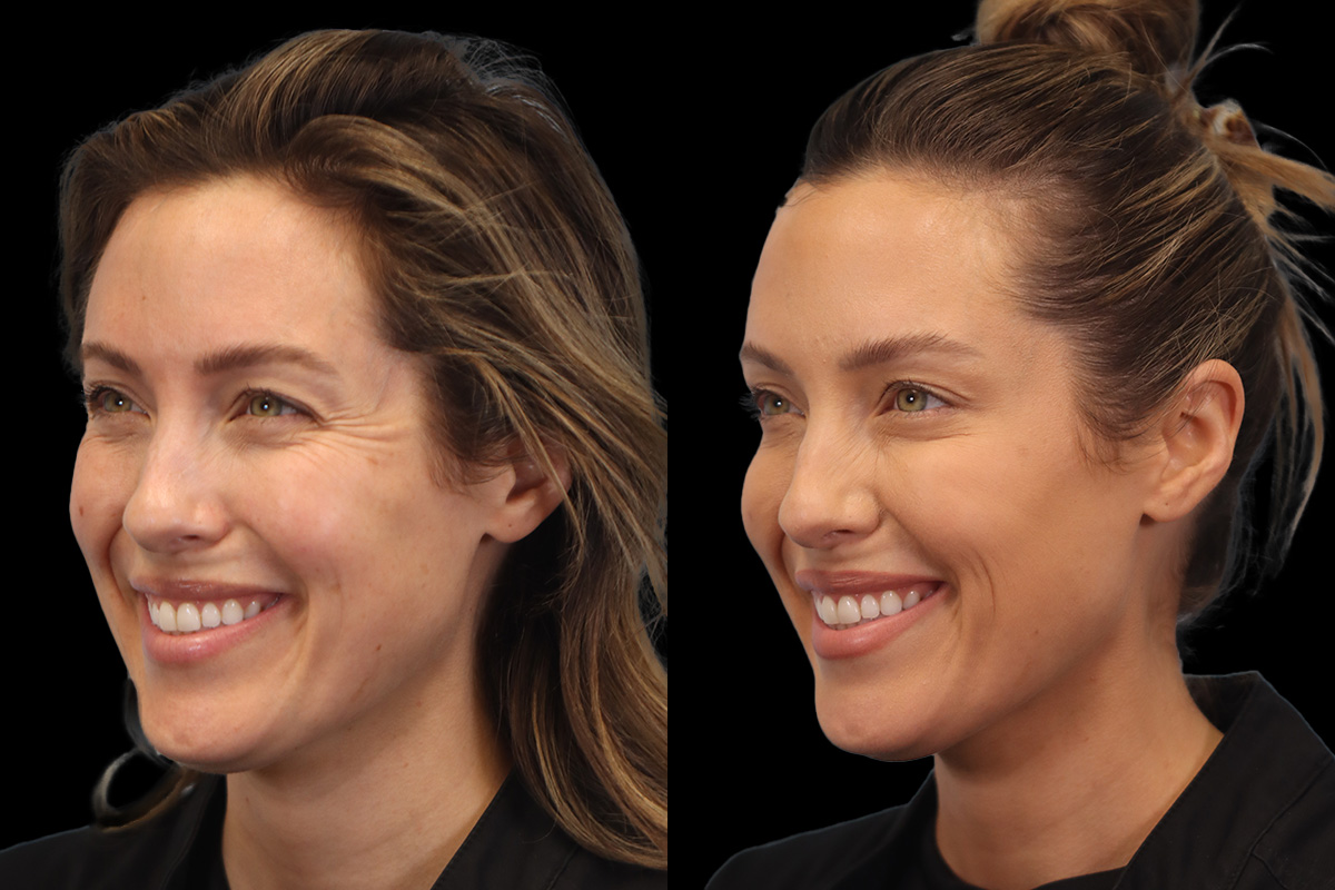 Botox® Cosmetic/ Dysport Before & After Gallery - Patient 589592 - Image 1