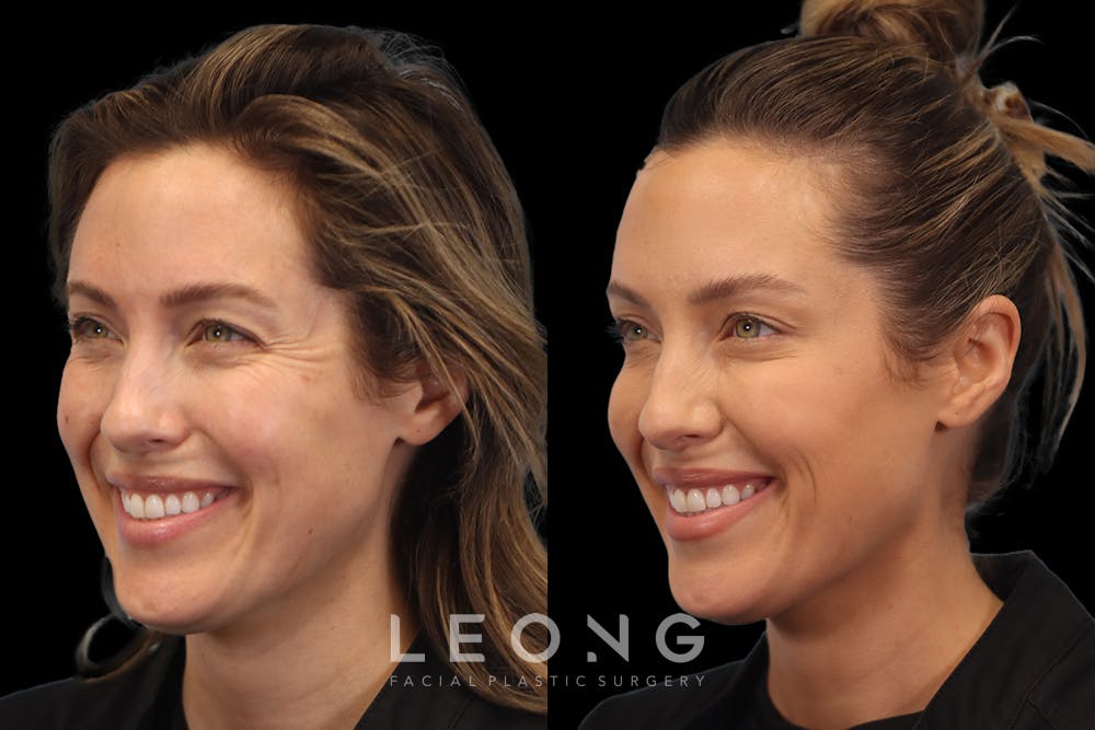 Botox® Cosmetic/ Dysport Before & After Gallery - Patient 589592 - Image 1