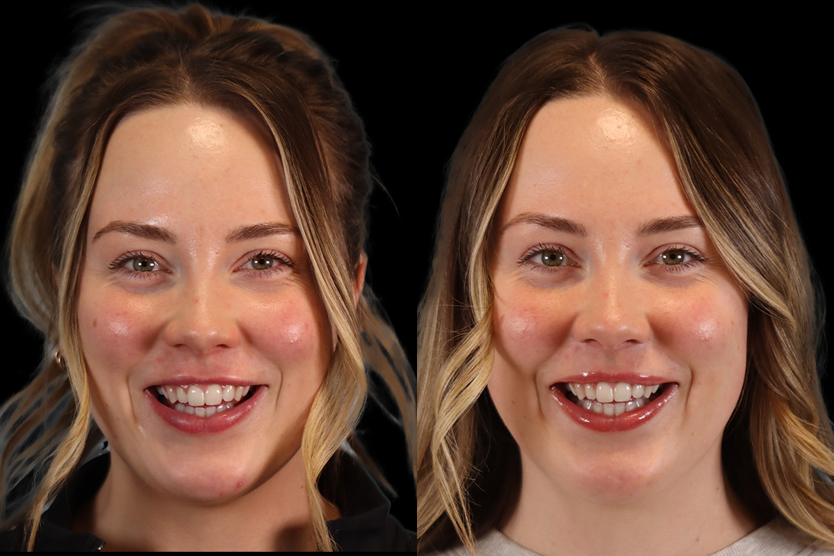Botox® Cosmetic/ Dysport Before & After Gallery - Patient 330759 - Image 1