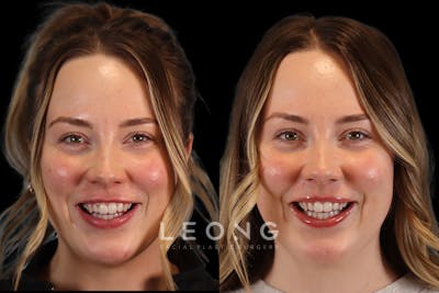 Botox® Cosmetic/ Dysport Before & After Gallery - Patient 330759 - Image 1