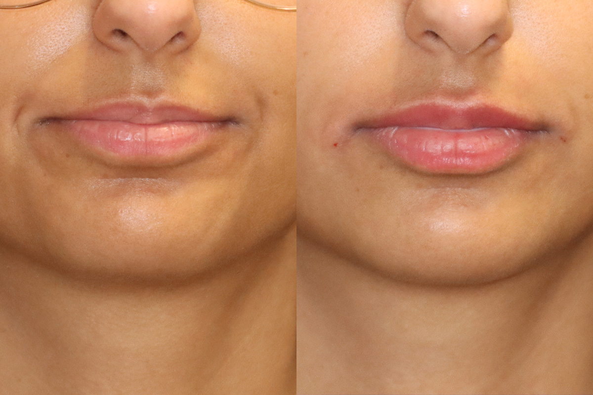 Lips Before & After Gallery - Patient 197241 - Image 1