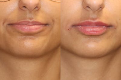 Lip Augmentation Before & After Gallery - Patient 265733 - Image 1