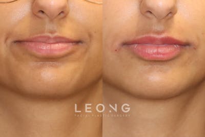 Lips Before & After Gallery - Patient 197241 - Image 1