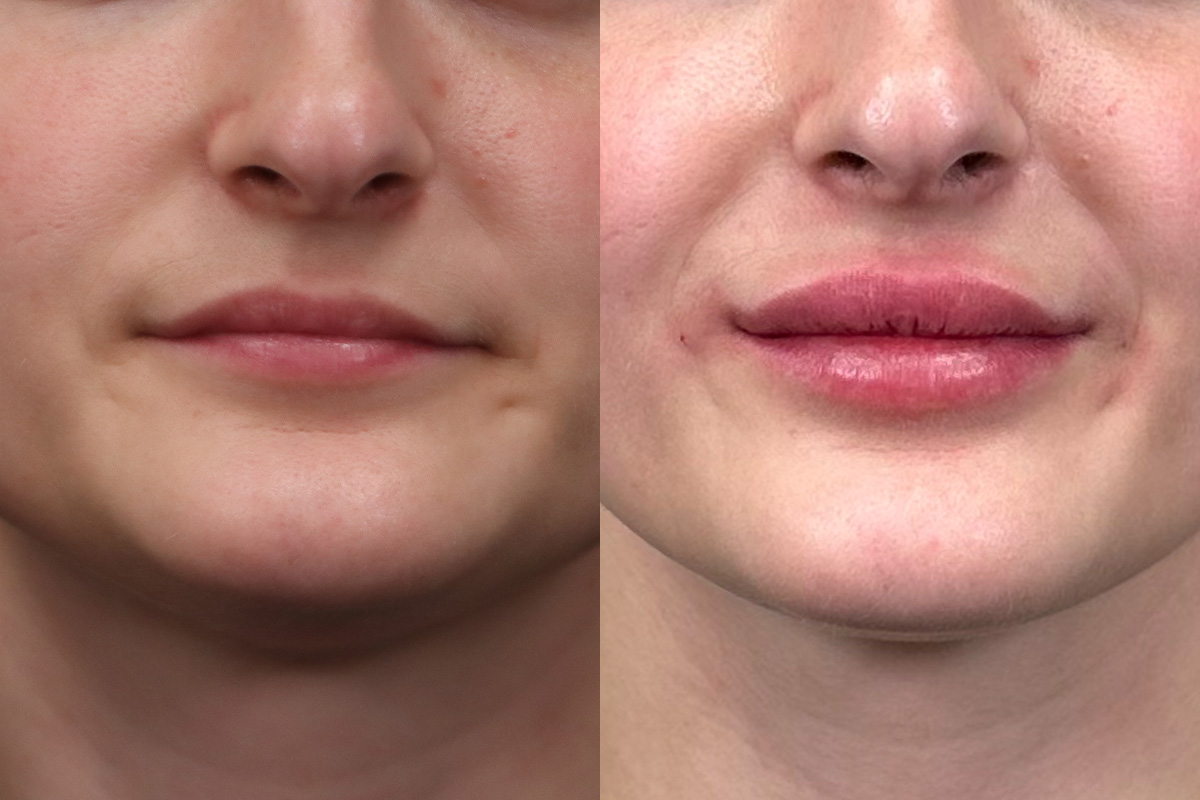 Lip Augmentation Before & After Gallery - Patient 367815 - Image 1