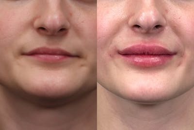 Lip Augmentation Before & After Gallery - Patient 367815 - Image 1