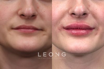 Lips Before & After Gallery - Patient 255398 - Image 1